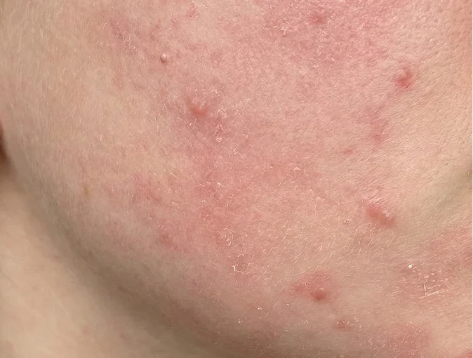 Công dụng PRO-RETINOL 0.6