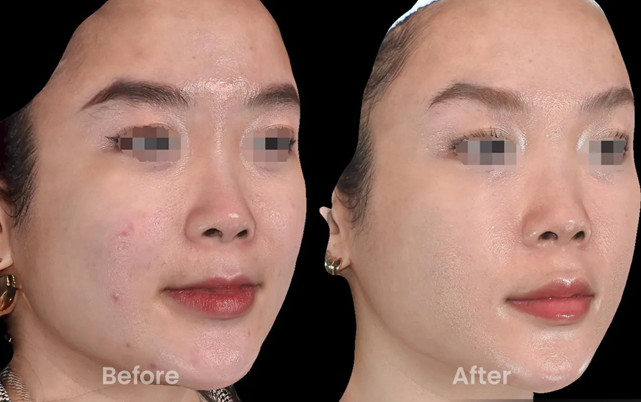 Kết quả lâm sàng sản phẩm 02 - Before và After